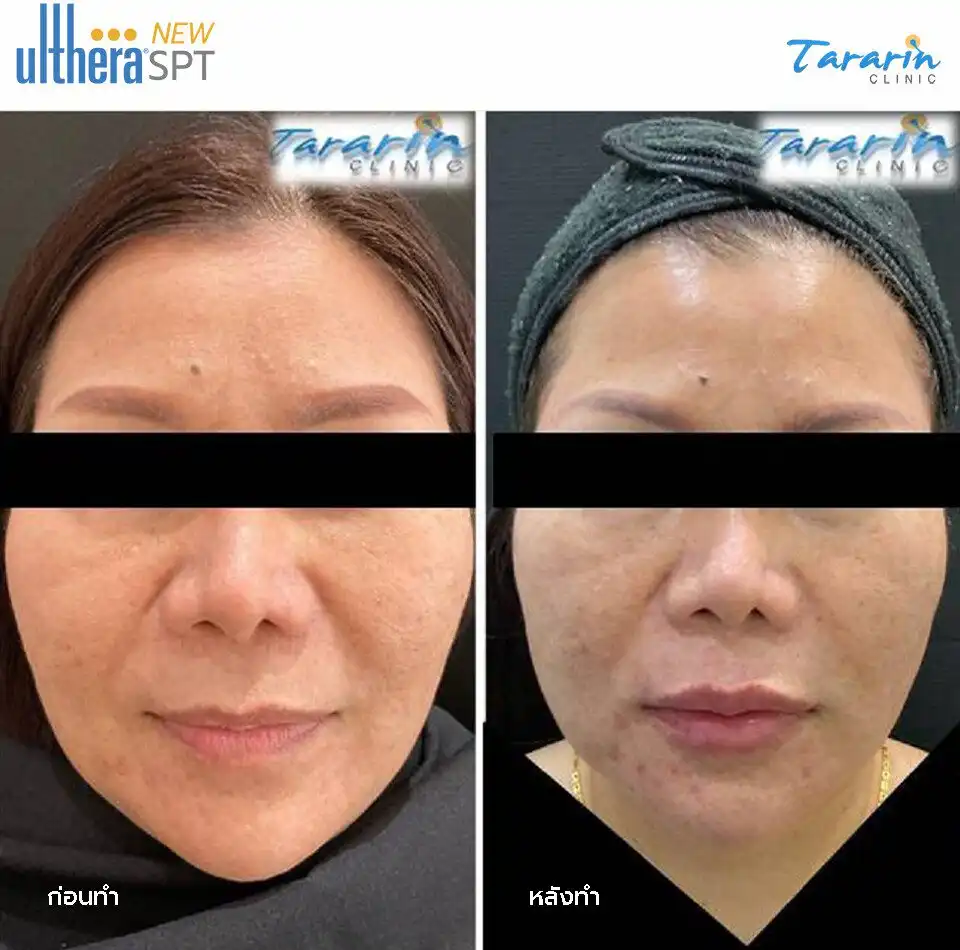 รีวิว New Ulthera SPT ผลลัพธ์ก่อนหลัง