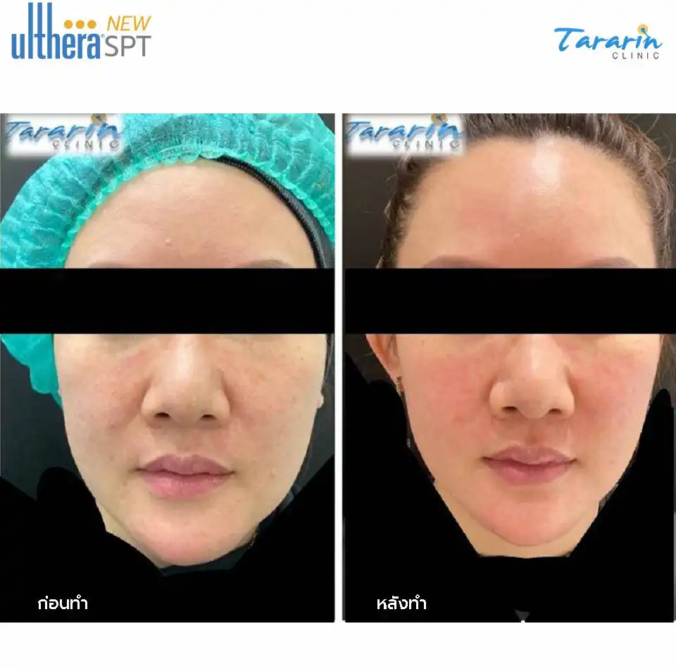 รีวิว New Ulthera SPT ผิวขาวใส กรอบหน้าชัด