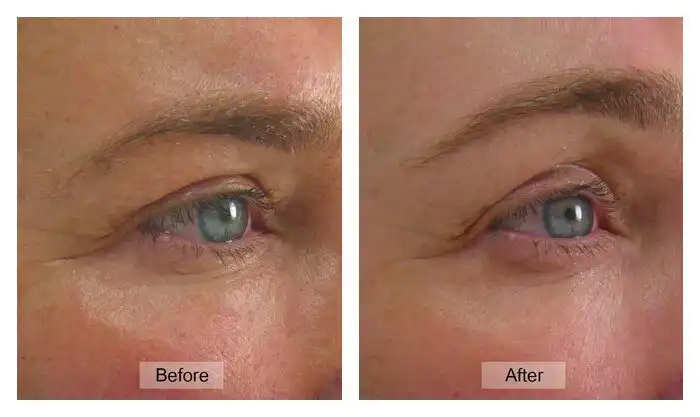 Ultherapy ยกกระชับหางคิ้ว คิ้วตกหนังตาตก