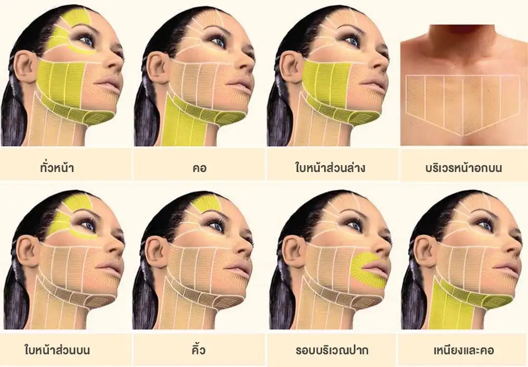 บริเวณที่สามารถทำ Ulthera ได้ ยกกระชับผิวหน้า ลำคอ ใต้คาง
