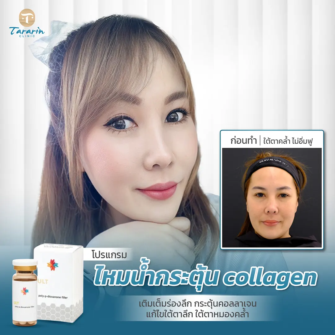ULTRACOL ผลลัพธ์หลังฉีดไหมน้ำ ผิวกระชับ ใต้ตาฟู ร่องแก้มลดลง