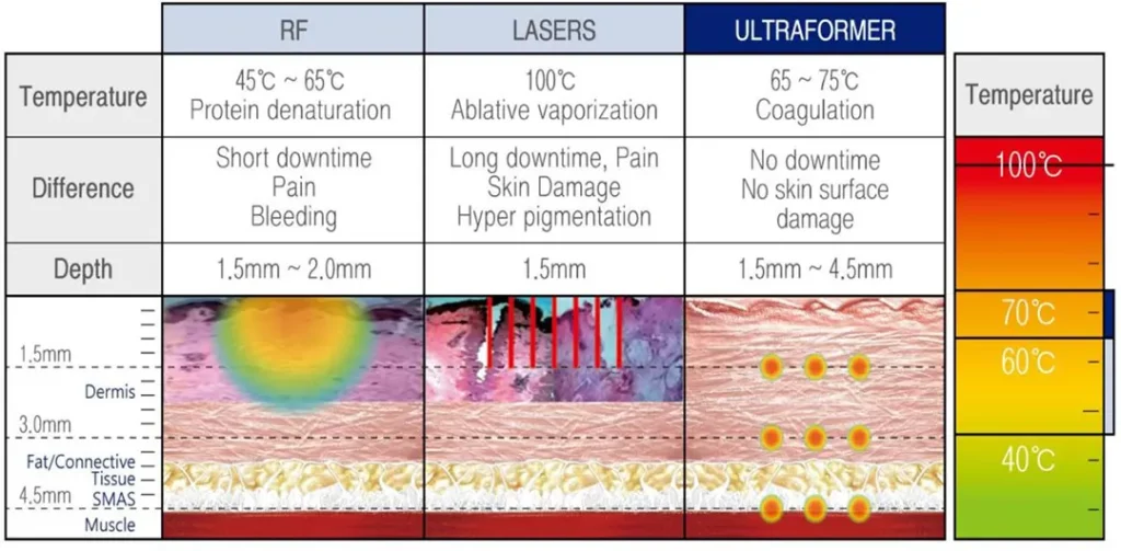 MFU Hyperthermia Lifting Therapy ชั้น SMAS ULTRAFORMER III