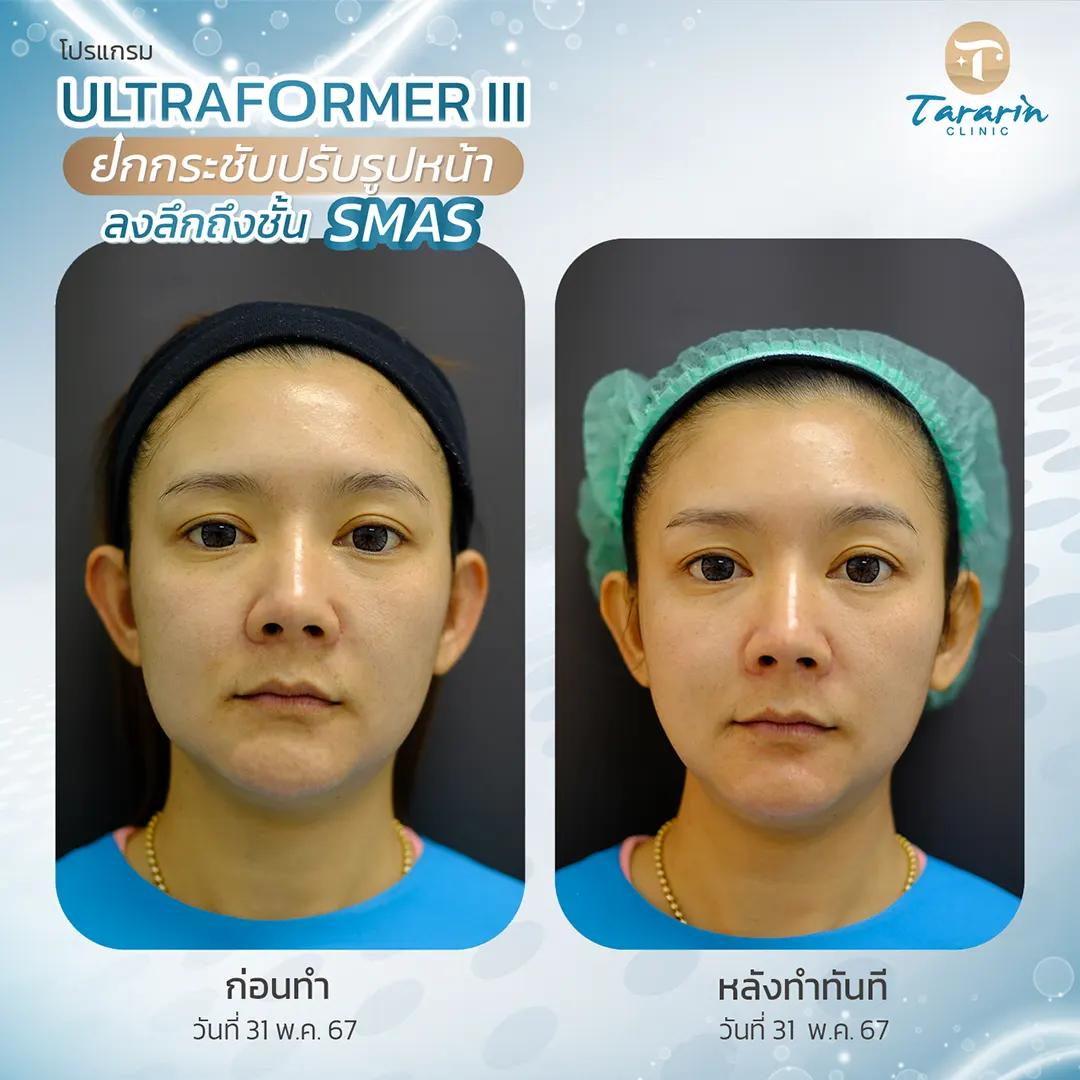 รีวิวผลการรักษา Ultraformer III ยกกระชับกรอบหน้า