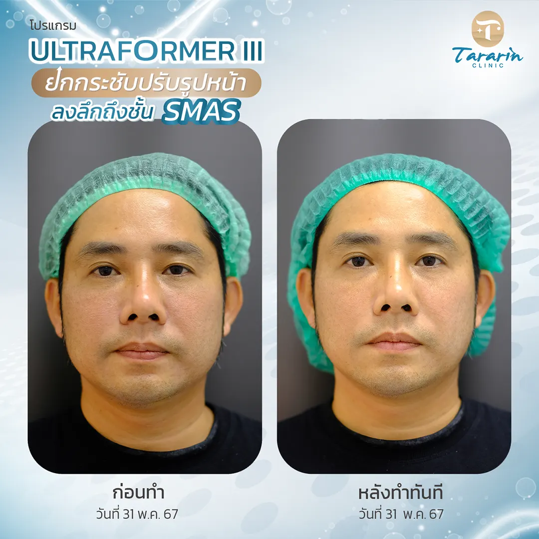 รีวิวผลการรักษา Ultraformer III ลดเหนียง กระชับผิว
