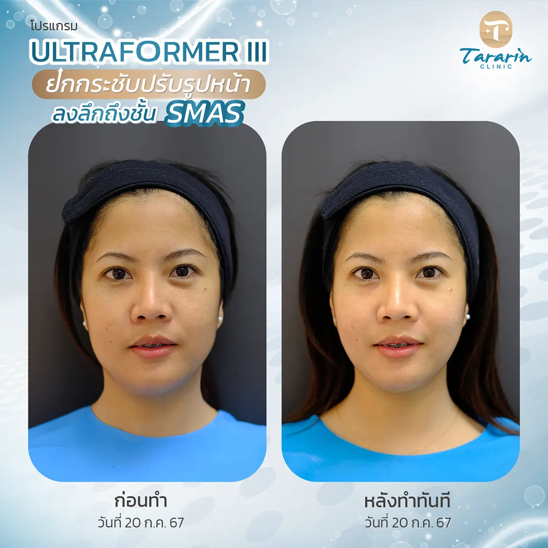 รีวิวผลการรักษา Ultraformer III ก่อนและหลัง