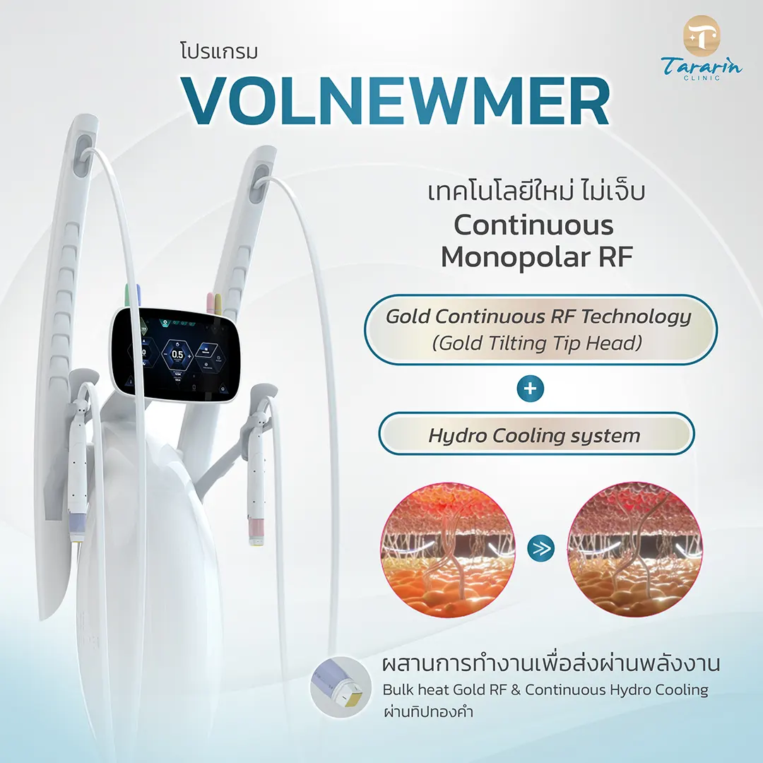 Volnewmer Monopolar RF 6.78 MHz ยกกระชับผิวหน้าและร่างกาย