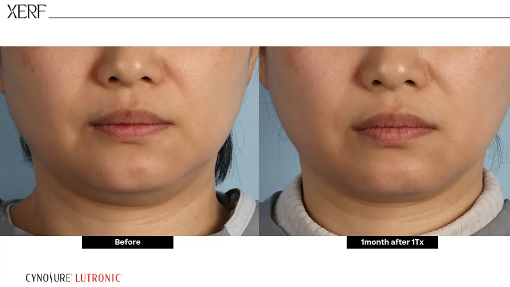 ผลลัพธ์ XERF ยกกระชับผิว Before-After ตัวอย่างที่ 6