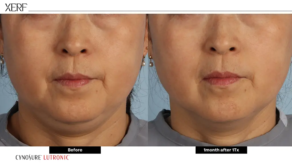 ผลลัพธ์ XERF ยกกระชับผิว Before-After ตัวอย่างที่ 7