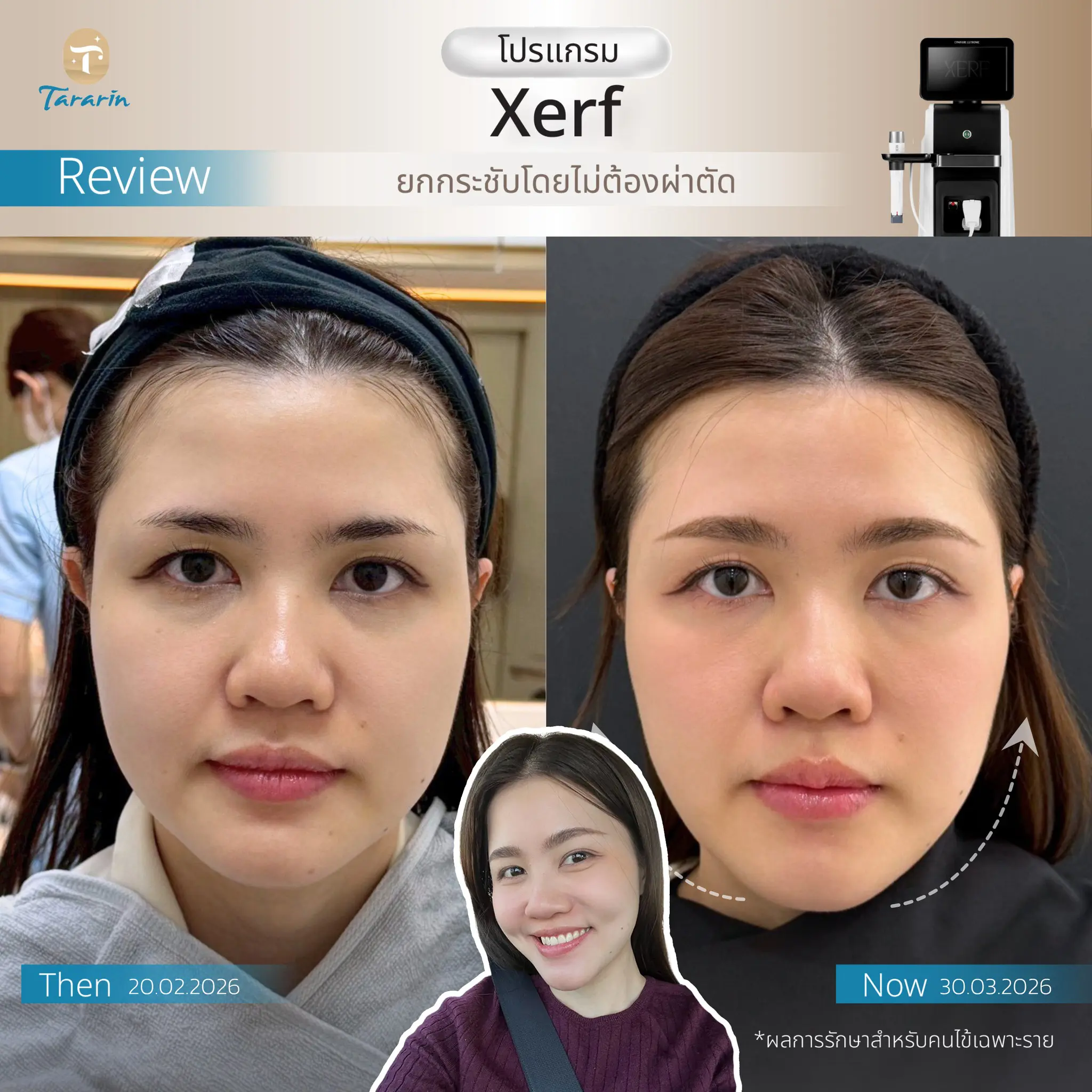 ผลลัพธ์ XERF ยกกระชับผิว Before-After ตัวอย่างที่ 1