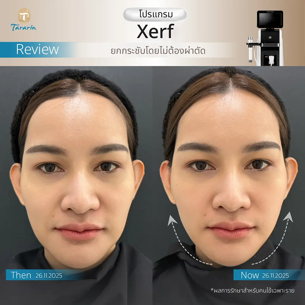 ผลลัพธ์ XERF ยกกระชับผิว Before-After ตัวอย่างที่ 2