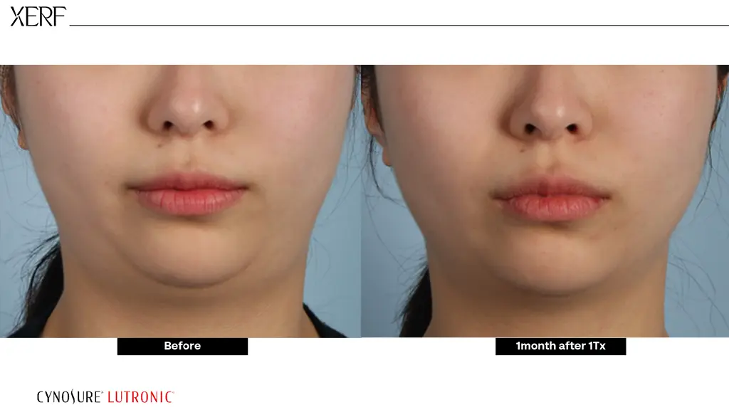 ผลลัพธ์ XERF ยกกระชับผิว Before-After ตัวอย่างที่ 3