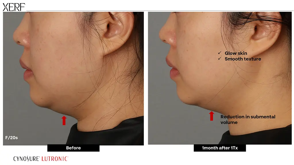 ผลลัพธ์ XERF ยกกระชับผิว Before-After ตัวอย่างที่ 4