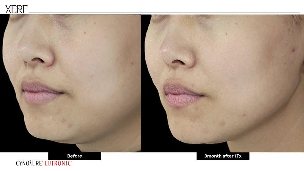 ผลลัพธ์ XERF ยกกระชับผิว Before-After ตัวอย่างที่ 5