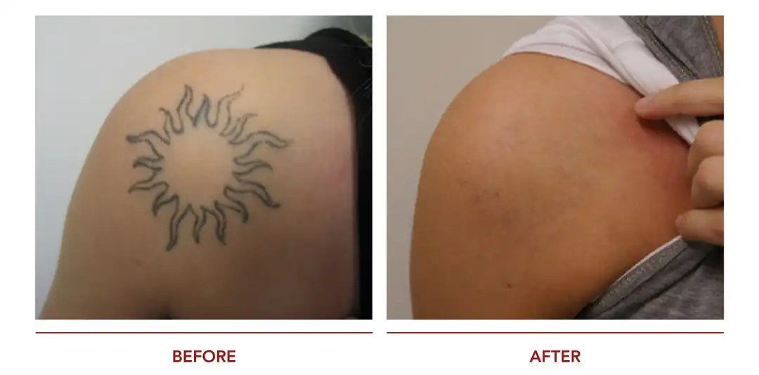 PicoTattoo ผลการลบรอยสัก Discovery Pico