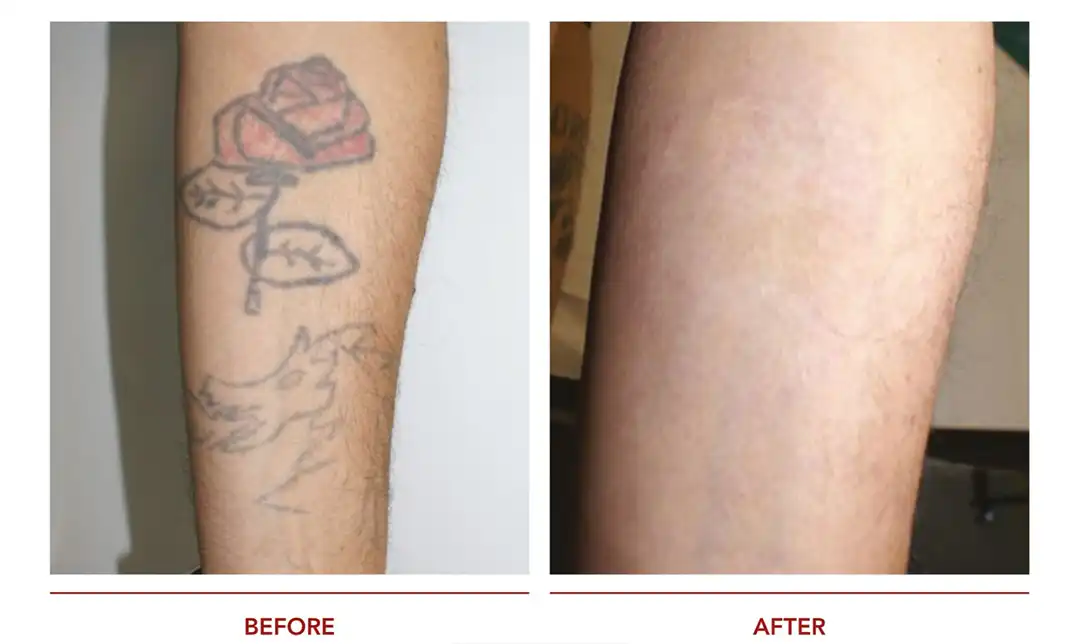 ลบรอยสักก่อน-หลัง Pico Tattoo Tararin Clinic