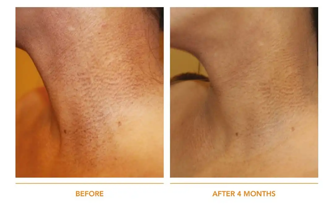 ผลการรักษาด้วย Pico Pigmented