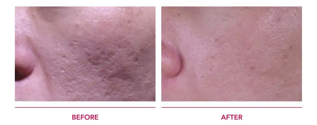PicoDeep รักษาหลุมสิว กระชับรูขุมขน แผลเป็น ด้วย Discovery Pico