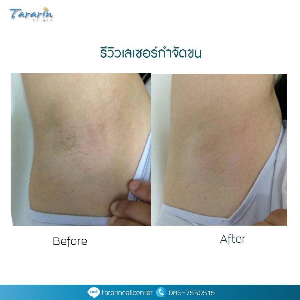 รีวิวเลเซอร์กำจัดขนผลลัพธ์จริง 1