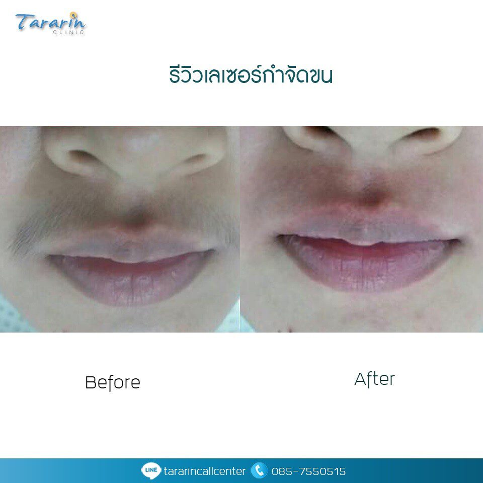 รีวิวเลเซอร์กำจัดขนรักแร้ 2