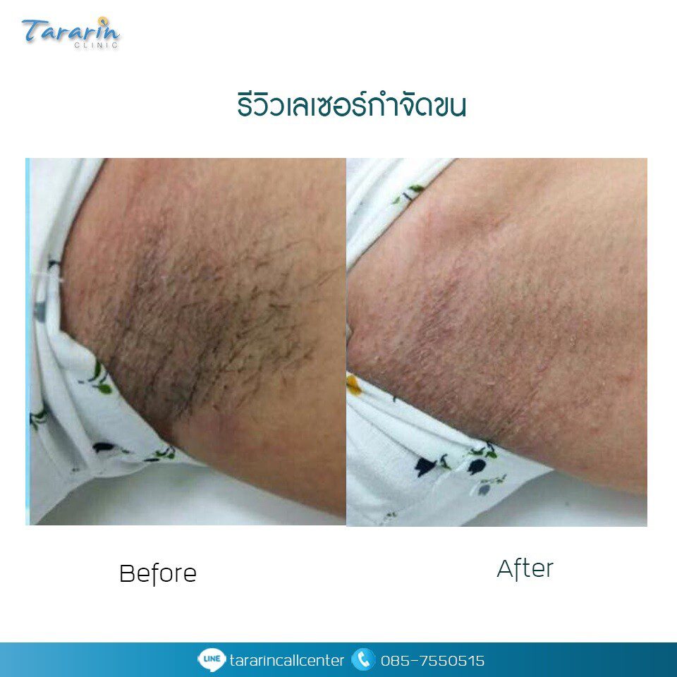 รีวิวเลเซอร์กำจัดขนขา 3