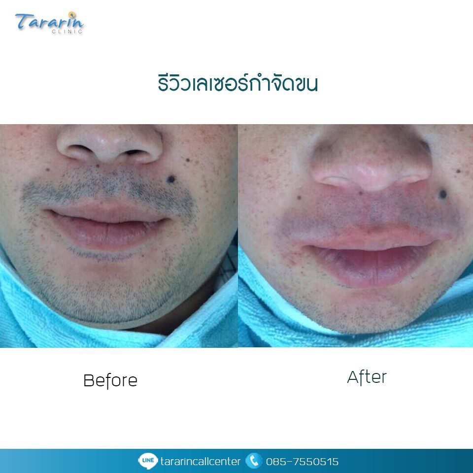 รีวิวเลเซอร์กำจัดขน Long Pulse ND Yag 4