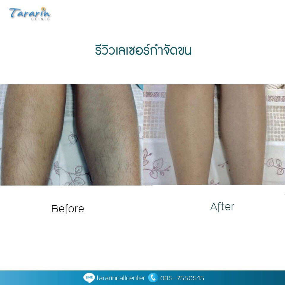 รีวิวเลเซอร์กำจัดขนก่อนหลัง 5