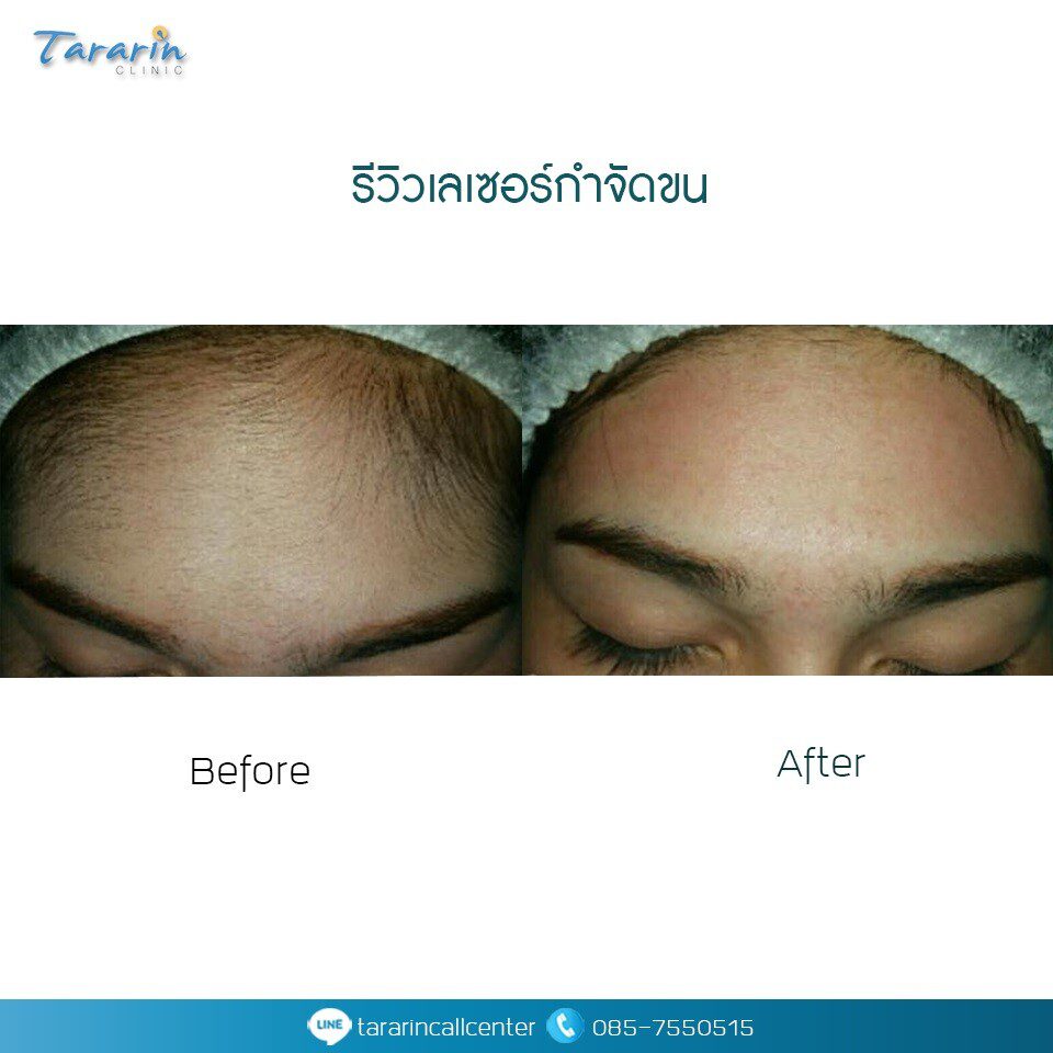 รีวิวเลเซอร์กำจัดขนก่อนหลัง 6