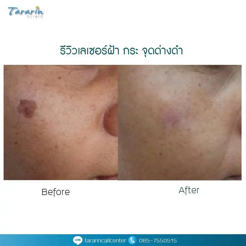 รีวิวเลเซอร์ฝ้า กระ จุดด่างดำ ผลลัพธ์ก่อน-หลัง