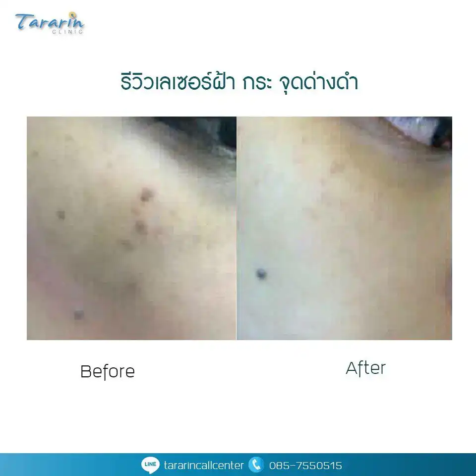 รีวิวเลเซอร์ฝ้า หน้าใสขึ้นหลังทำที่ธารารินคลินิก