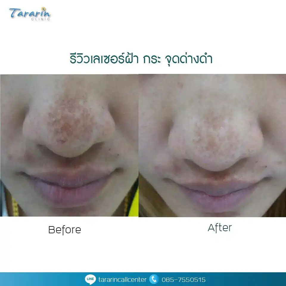 รีวิวรักษาฝ้า กระ จุดด่างดำ ก่อน-หลังทำเลเซอร์