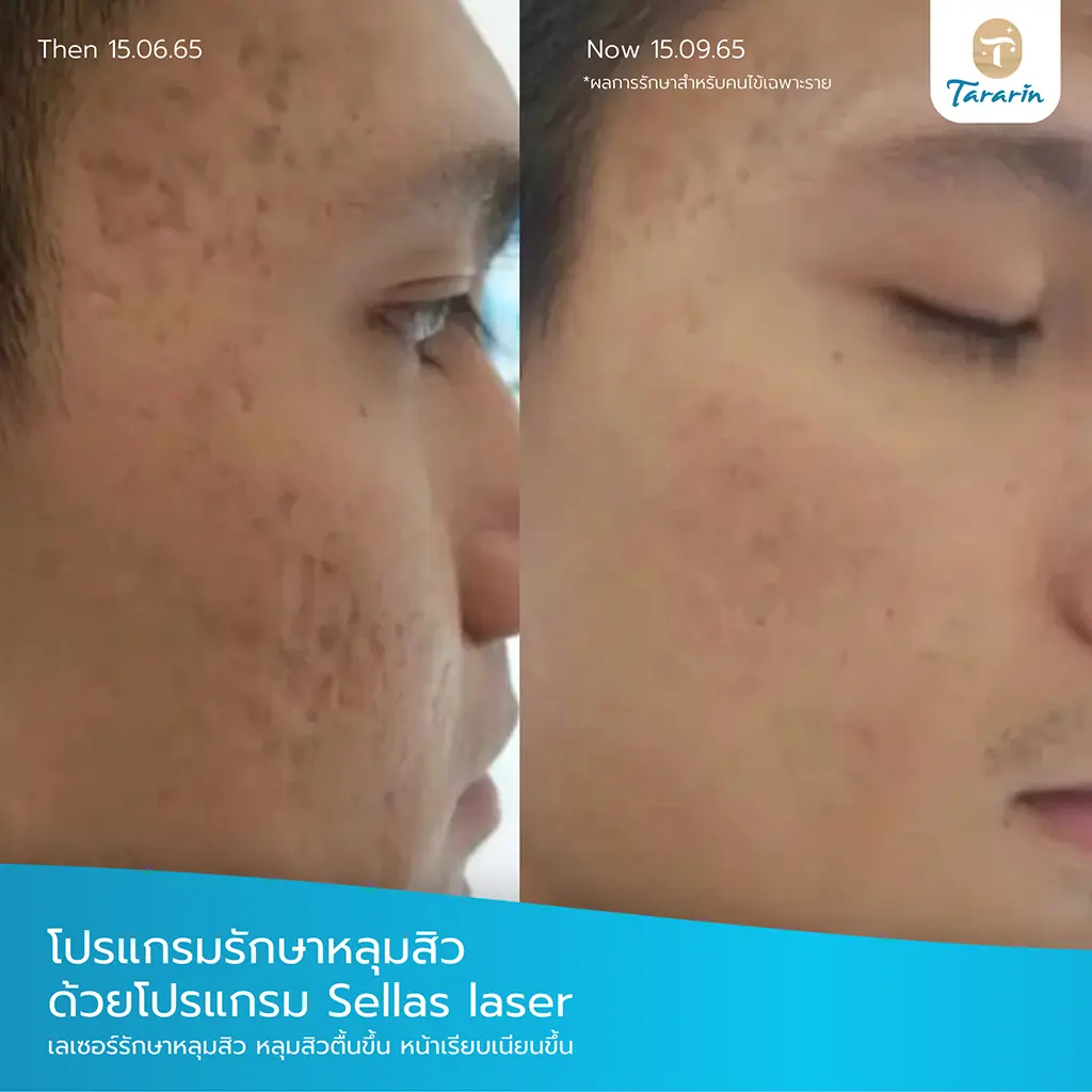 รีวิวเลเซอร์หลุมสิว Sellas Laser ก่อน-หลัง