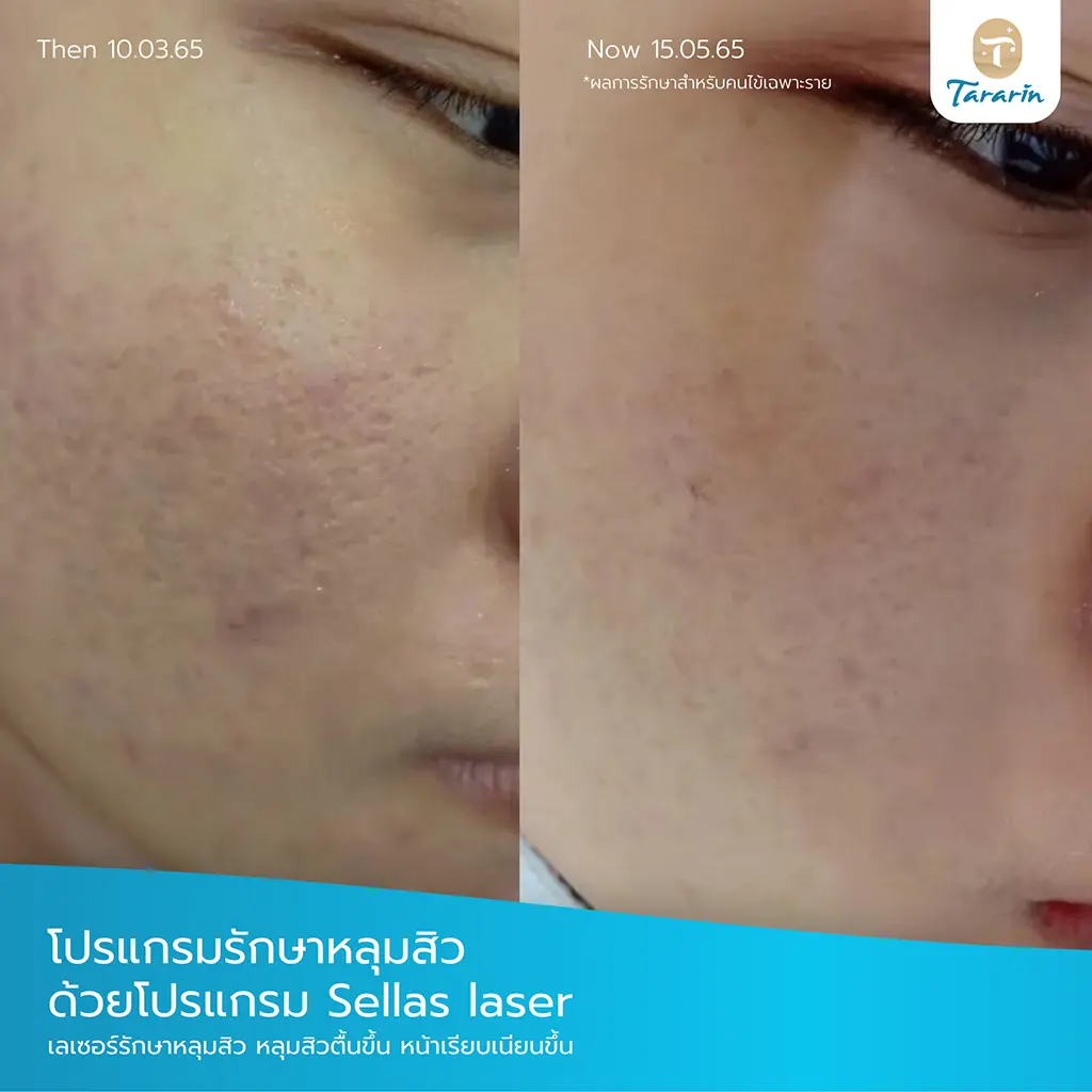 ผลการรักษาหลุมสิว Sellas Laser