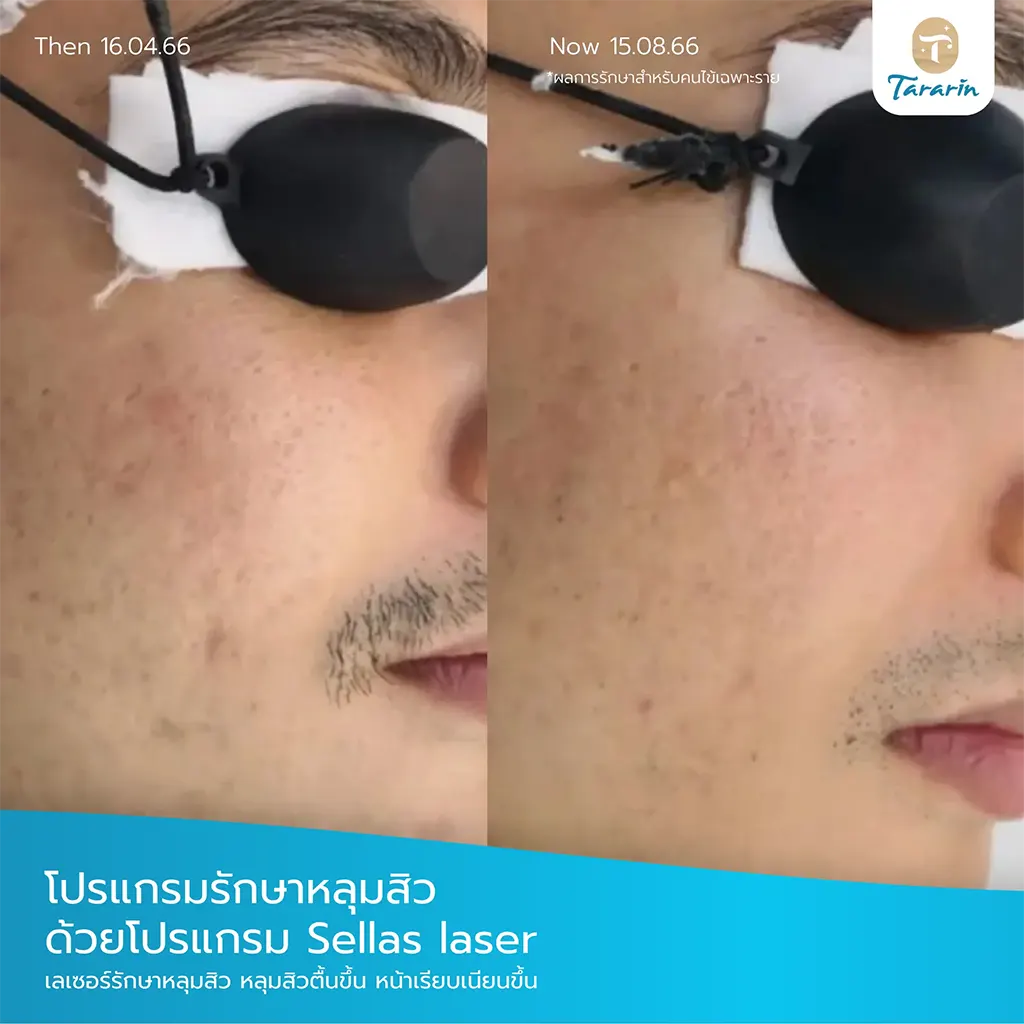รีวิวรักษารูขุมขนกว้าง ผิวเรียบเนียนขึ้น