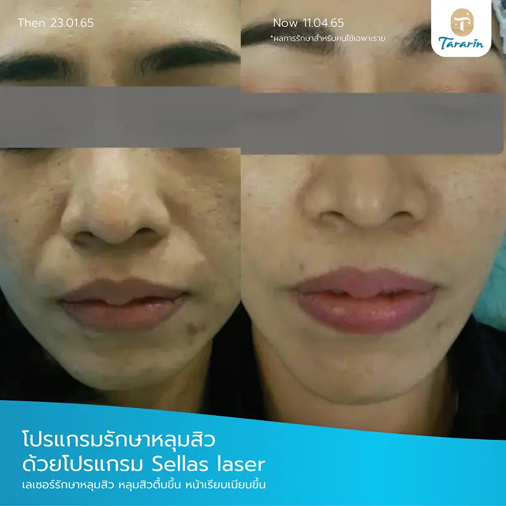 รีวิวรักษารอยแตกลาย Smooth Fractional Laser