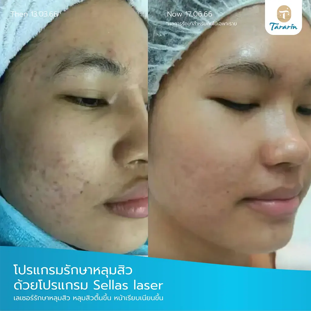 ผลก่อนหลังเลเซอร์หลุมสิว Sellas Laser