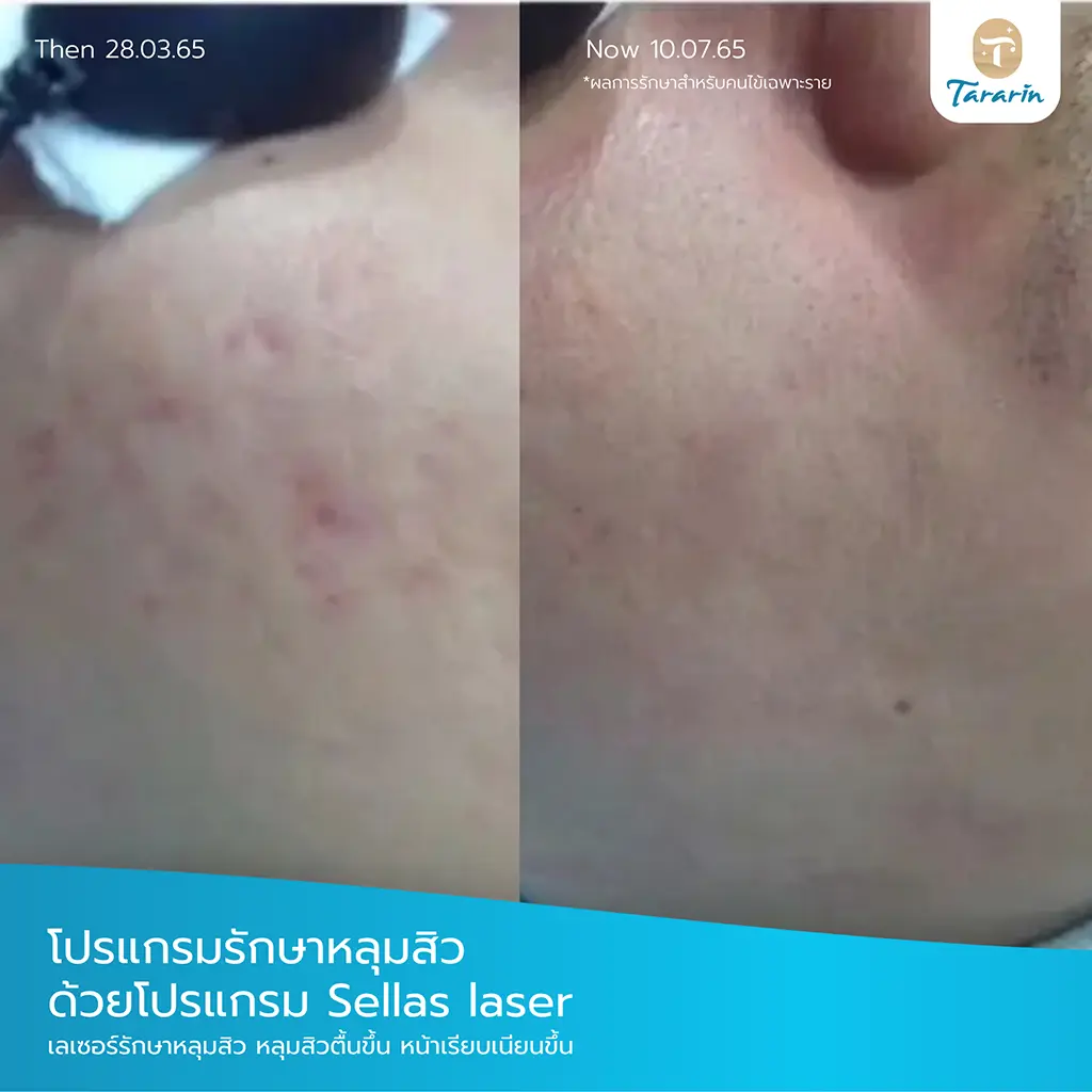 รีวิวผิวเรียบขึ้นหลังทำ Sellas Laser