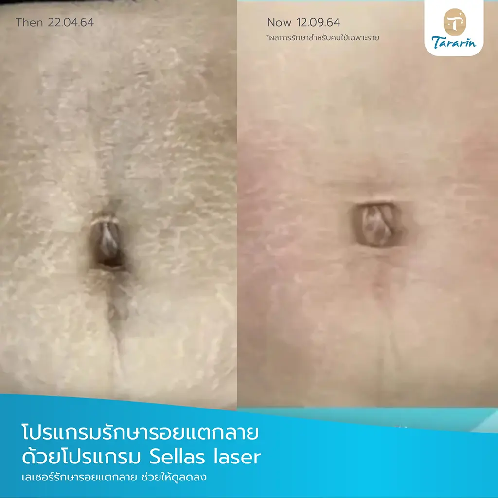 ผลการรักษา Ice Pick Scar Sellas Laser