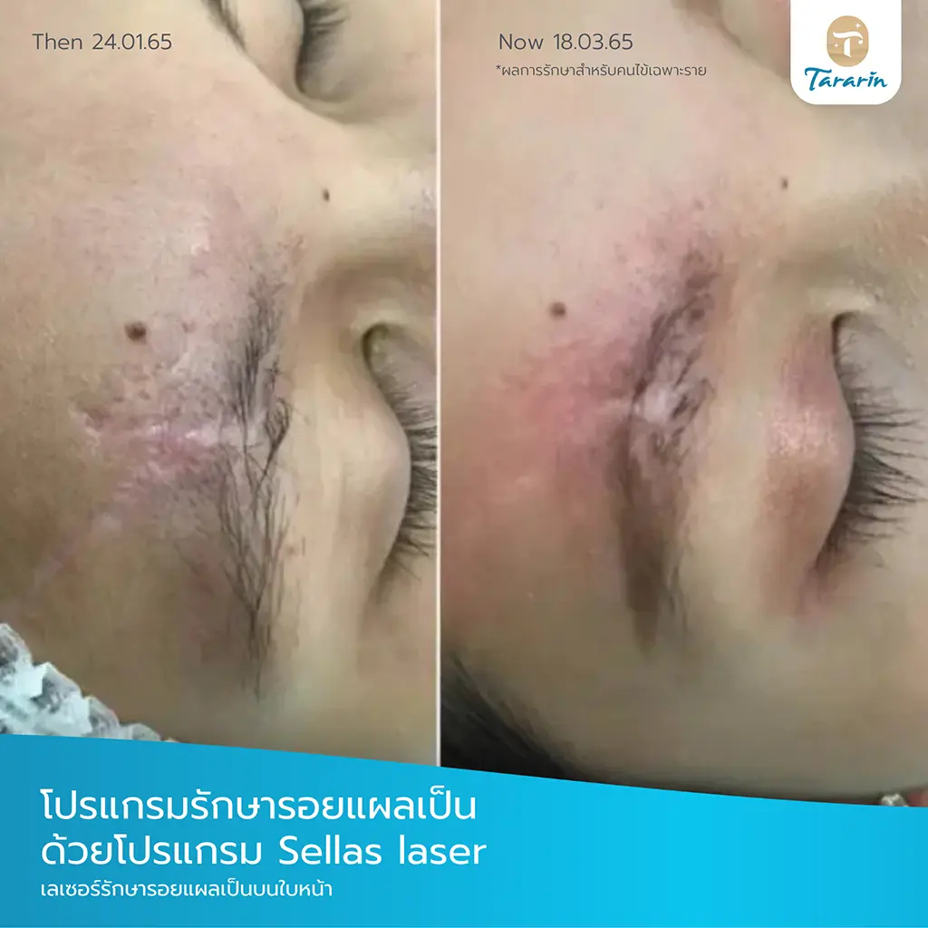 รีวิวเลเซอร์ Boxed Scar Rolling Scar