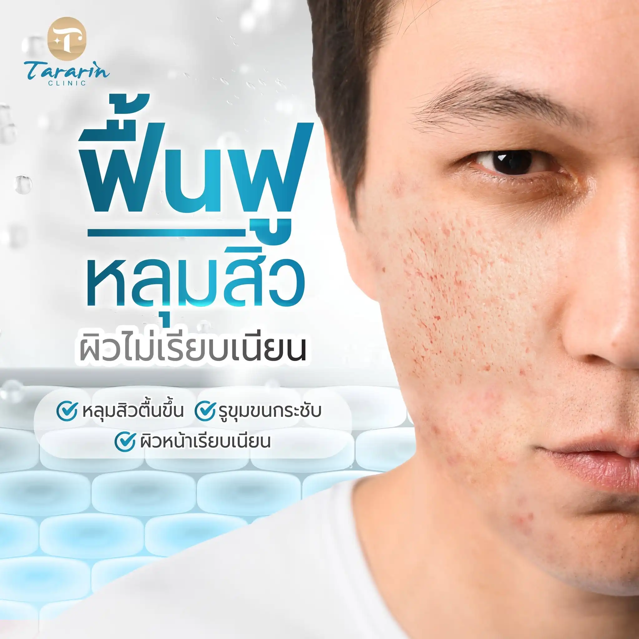 เลเซอร์หลุมสิว รูขุมขนกว้าง รอยแตกลาย