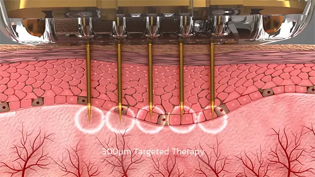 Sylfirm x plus RF Microneedling นวัตกรรม Dual Wave ฟื้นฟูผิว