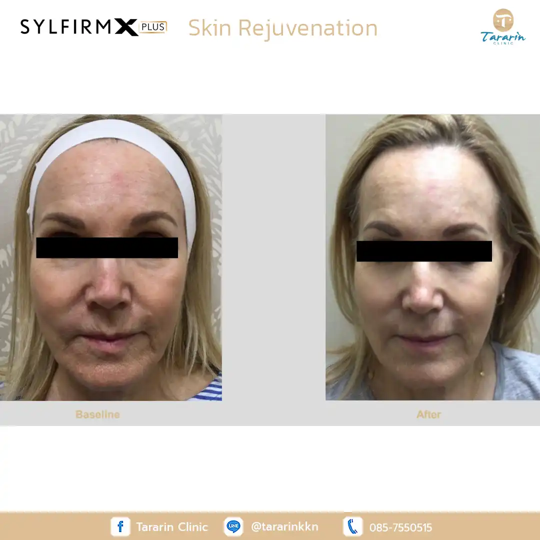 รีวิว Sylfirm x plus ผลลัพธ์ผิวเรียบเนียน