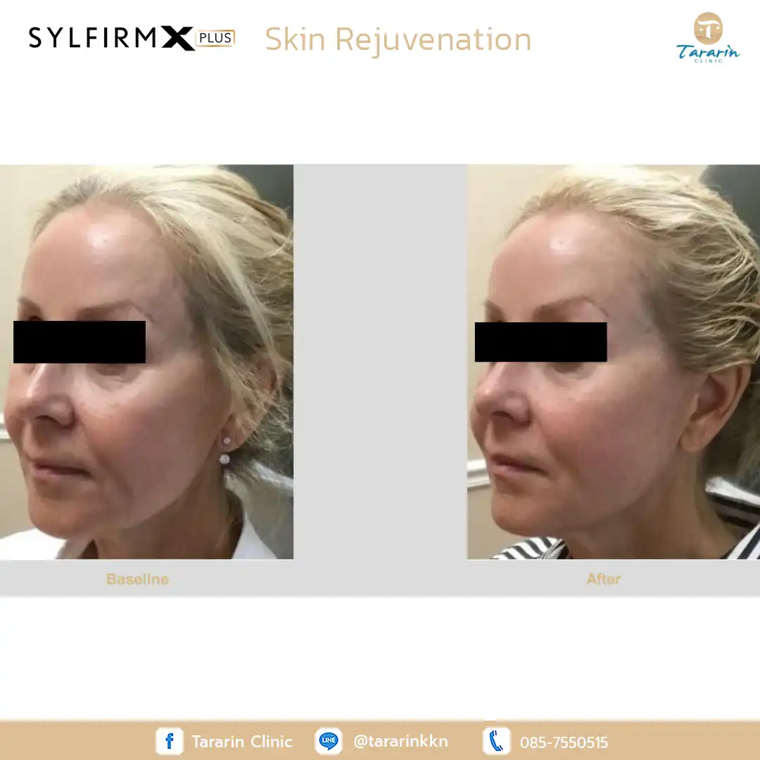 รีวิว Sylfirm x plus ผลลัพธ์ลดริ้วรอย