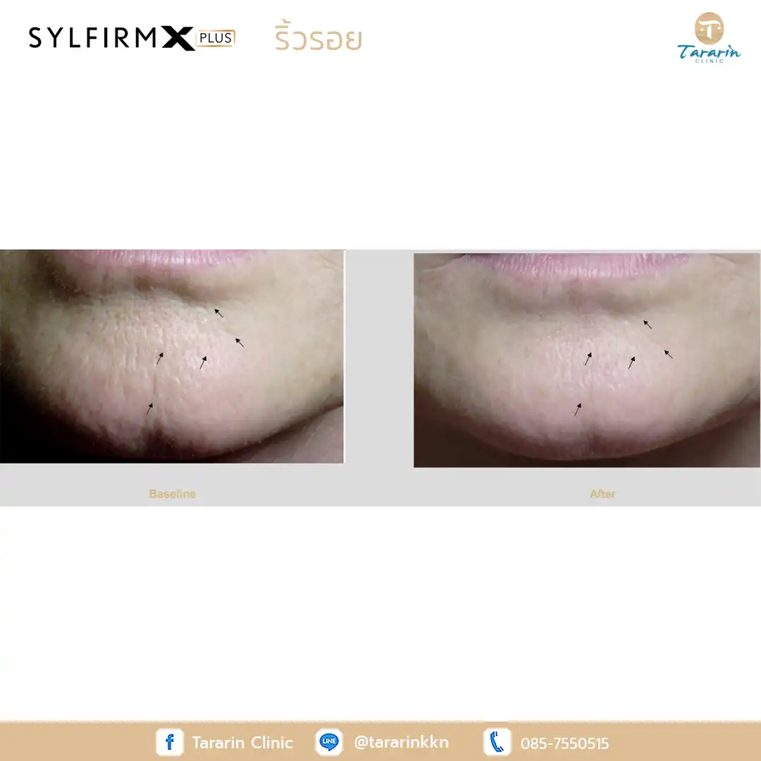 รีวิว Sylfirm x plus ผลลัพธ์ยกกระชับหน้า