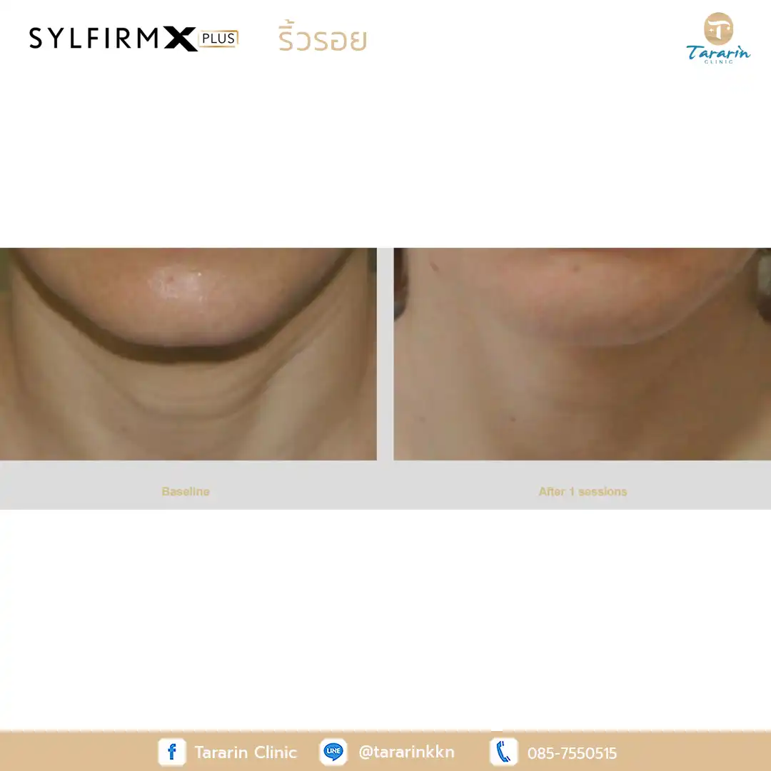 รีวิว Sylfirm x plus ผลลัพธ์รักษาผิวหมองคล้า