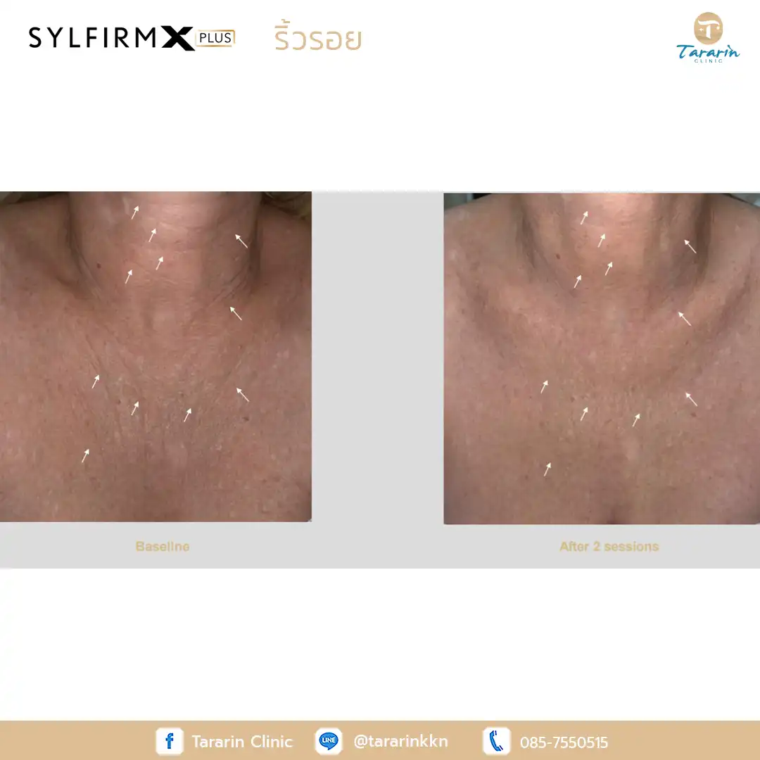 รีวิว Sylfirm x plus ผลลัพธ์ก่อนหลัง