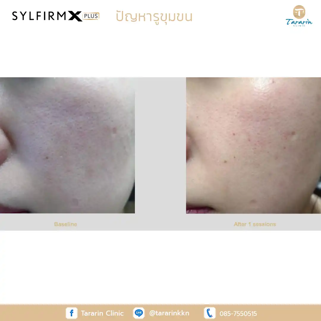 รีวิว Sylfirm x plus ผลลัพธ์รักษารอยแดงสิว