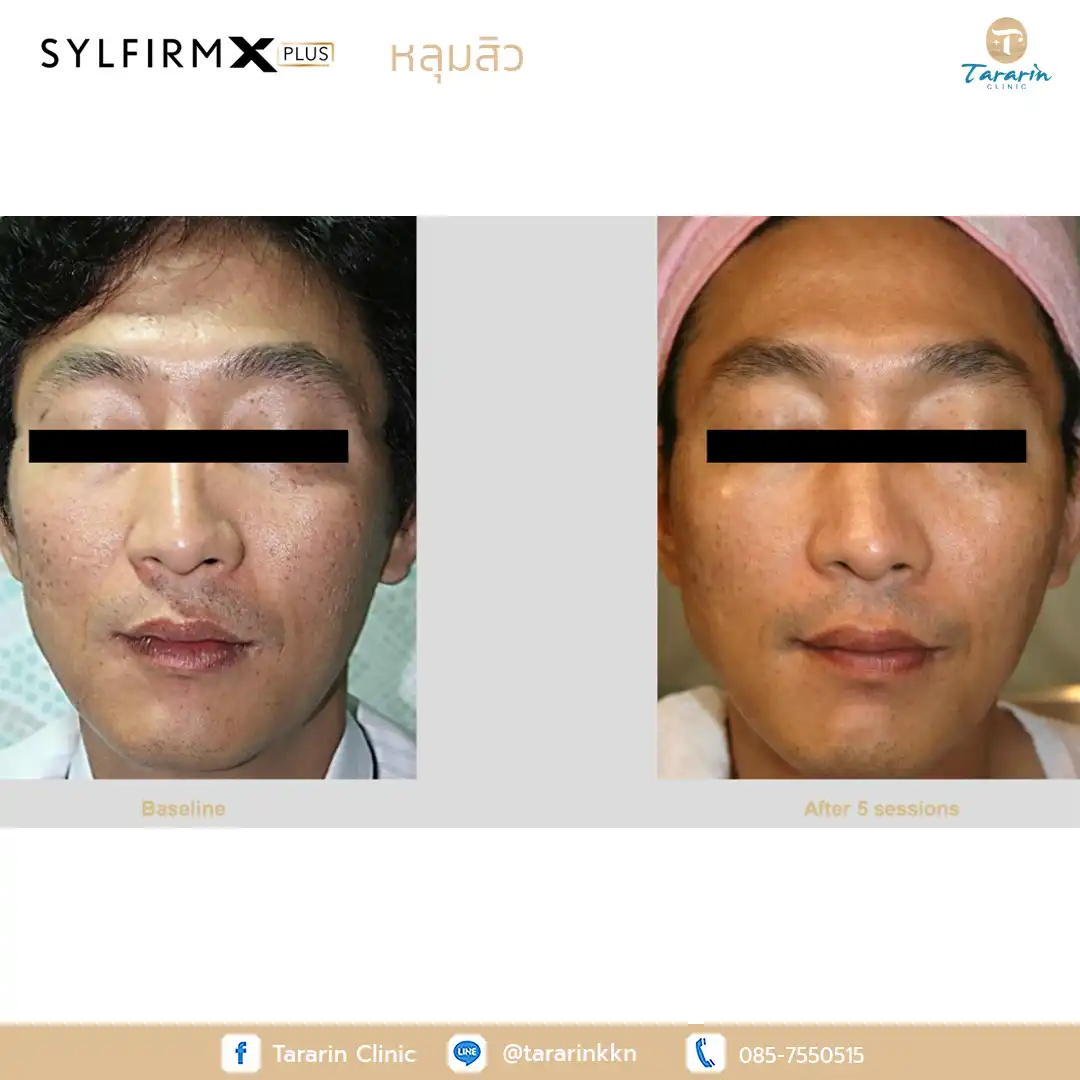 รีวิว Sylfirm x plus ผลลัพธ์รักษาหลุมสิวขอนแก่น