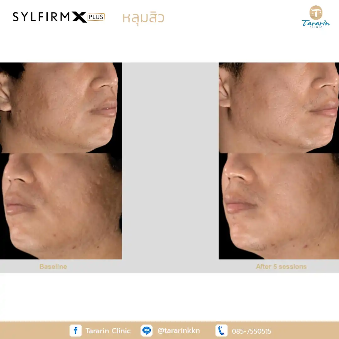 รีวิว Sylfirm x plus ผลลัพธ์ผิวกระจ่างใส
