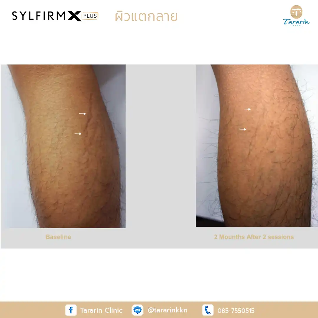 รีวิว Sylfirm x plus ผลลัพธ์รักษาแผลเป็น
