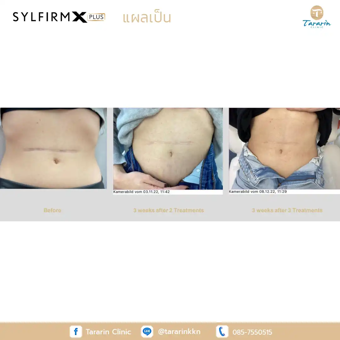 รีวิว Sylfirm x plus ผลลัพธ์รักษาผิวหยาบกร้าน